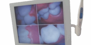 SET DE MONITOR Y CAMARA INTRAORAL ODONTUM